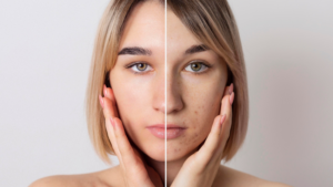 Considering Ozempic? Ozempic Face Explained